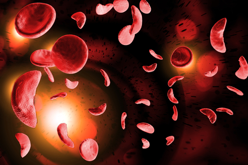 Red blood cells with sickle cell anemia