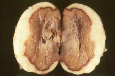 Pythium leak on potato