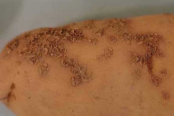 Close-up of a potato tuber with small, rough, scaly lesions scattered across the surface. The patches are brown and slightly raised, showing typical symptoms of common scab infection.