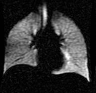Magnetic resonance imaging (MRI) image of human lungs