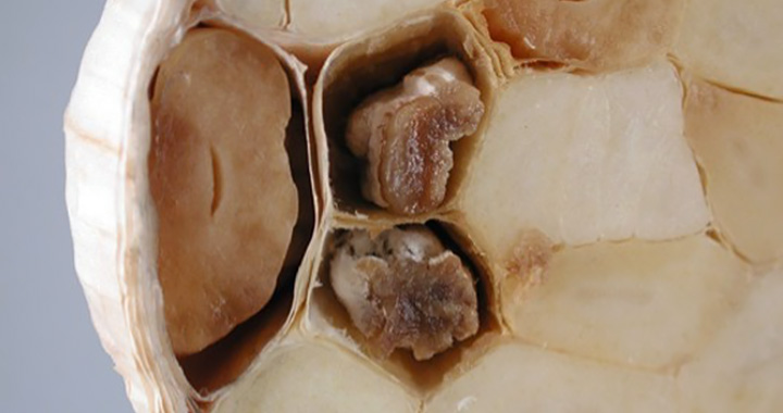 Basal rot on garlic cloves