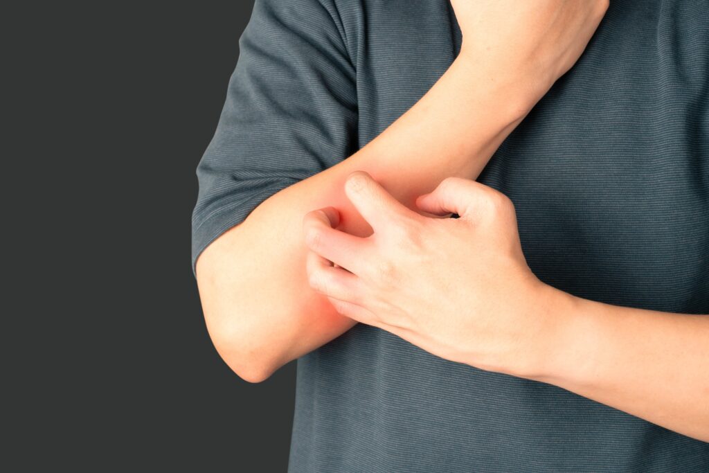 A photo of a person with atopic dermatitis scratching the right forearm.