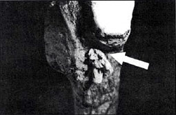 Bone spear point broken off in rib.