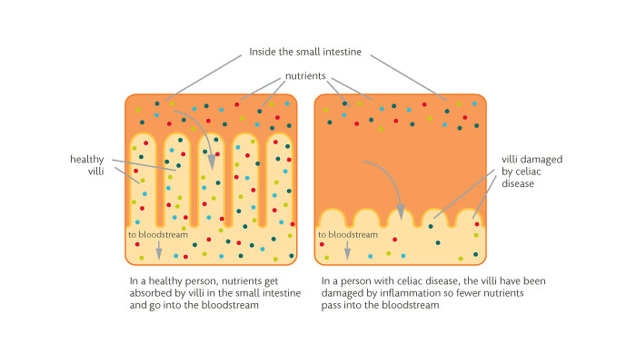 Infographic of celiac disease intestine