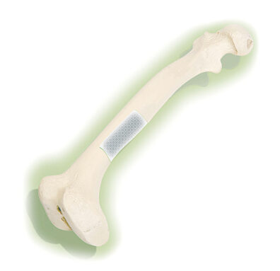 Illustration of a bone with a 3D-printed scaffold to support bone while it heals
