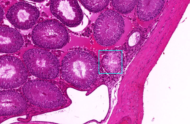 A microscopic image of tissue stained pink and purple, showing multiple circular and oval structures with dense cell patterns. One of the structures near the right side of the image is outlined with a light blue box, highlighting a specific tubule or cell cluster. The surrounding area contains tightly packed cells with visible internal textures and a lighter, irregularly shaped region at the lower center.