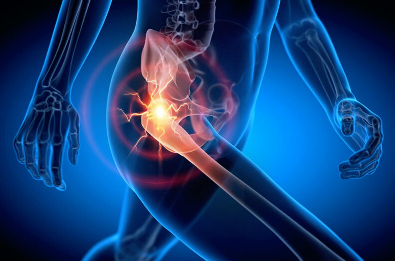 Artistic x-ray like rendering while a person in motion is experiencing hip pain.